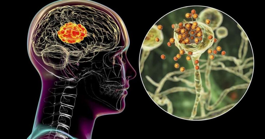 Neurological Symptoms Of Mold Exposure: Protecting Your Brain And Nervous System From Harm