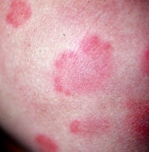 Symptoms Of Mold Exposure Rash: Identifying Skin Reactions To Mold