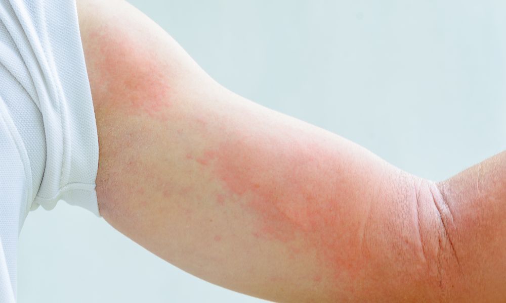 Symptoms Of Mold Exposure Rash: Identifying Skin Reactions To Mold